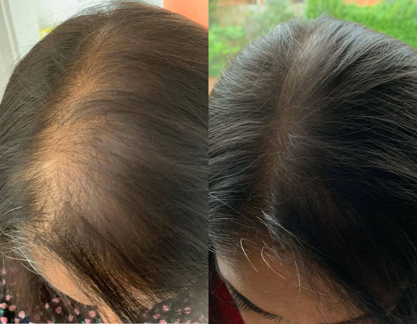 Crown &amp; Bloom™ - سيروم نباتي لنمو الشعر يحفز بصيلات الشعر ويمنع هرمون DHT