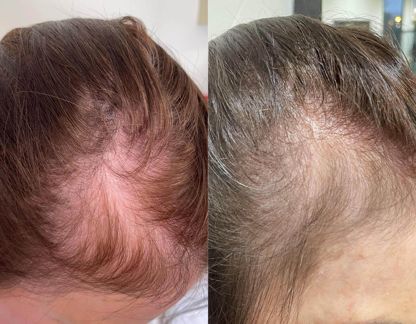 Crown &amp; Bloom™ - سيروم نباتي لنمو الشعر يحفز بصيلات الشعر ويمنع هرمون DHT