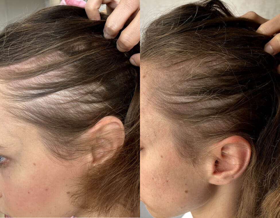 Crown &amp; Bloom™ - سيروم نباتي لنمو الشعر يحفز بصيلات الشعر ويمنع هرمون DHT