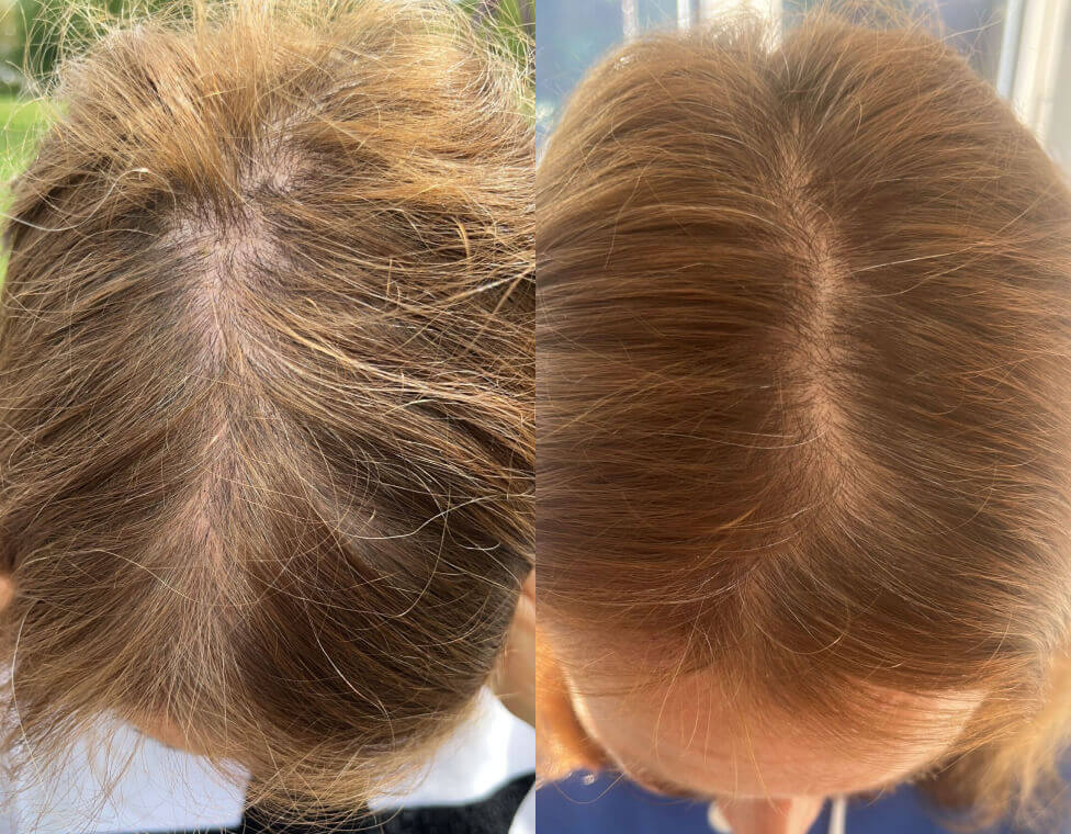 Crown &amp; Bloom™ - سيروم نباتي لنمو الشعر يحفز بصيلات الشعر ويمنع هرمون DHT