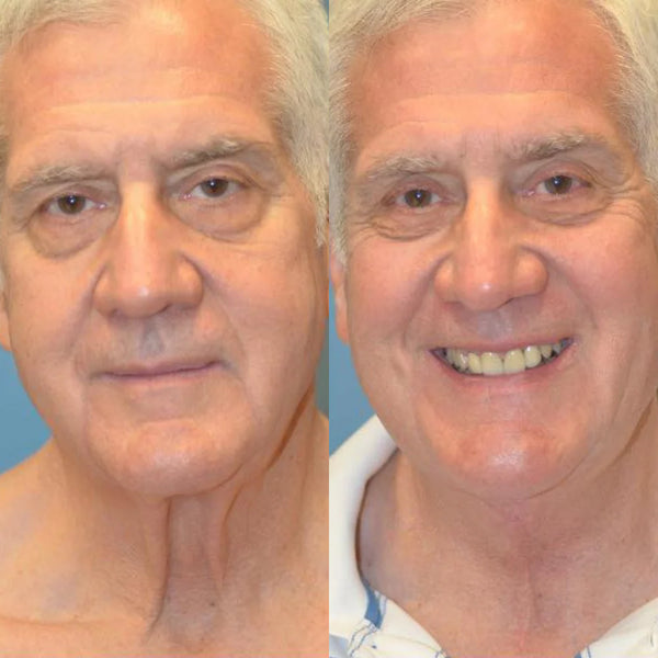 نتائج قبل وبعد استخدام Venus LiftFX على رجل